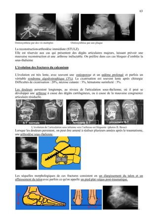 63
Ostéosynthèse par des vis multiples Ostéosynthèse par une plaque
La reconstruction-arthrodèse immédiate (STULZ).
Elle est réservée aux cas qui présentent des dégâts articulaires majeurs, laissant prévoir une
mauvaise reconstruction et une .arthrose inéluctable. On préfère dans ces cas bloquer d’emblée la
sous-thalienne
L'évolution des fractures du calcanéum
L'évolution est très lente, avec souvent une ostéoporose et un œdème prolongé et parfois un
véritable syndrome algodystrophique (3%). La cicatrisation est souvent lente après chirurgie
Difficultés de cicatrisation : 20%, nécrose cutanée : 3%, hématome surinfecté : 3%.
Les douleurs persistent longtemps, au niveau de l'articulation sous-thalienne, où il peut se
développer une arthrose à cause des dégâts cartilagineux, ou à cause de la mauvaise congruence
articulaire résiduelle.
L’évolution de l’articulation sous talienne vers l’arthrose est fréquente (photos JL Besse)
Lorsque les douleurs persistent, on peut être amené à réaliser plusieurs années après le traumatisme,
une arthrodèse sous-thalienne.
Les séquelles morphologiques de ces fractures consistent en un élargissement du talon et un
affaissement du talonavec parfois ce qu'on appelle un pied plat valgus post-traumatique.
-
pincement S-Tremodelé S-TS-T normale
 