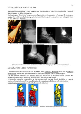 65
2/ L'ÉNUCLÉATION DE L'ASTRAGALE
Au cours d'un traumatisme violent associant une inversion forcée et une flexion plantaire, l'astragale
peut s'énucléer en dehors et en avant.
L'astragale perd alors toutes ses connexions ligamentaires et vasculaires et le risque de nécrose est
majeur. On préfère, malgré ce risque, tenter une réduction plutôt que de faire une astragalectomie
ou une arthrodèse d'emblée.
Enucléation du corps de l’astragale tentative de reconstruction avec évolution d’un nécrose avec consolidation
Astragalectomie dans le cas d’une énucléation complète où il n’était pas possible de conserver l’astragale
LES LUXATIONS MÉDIO-TARSIENNES
C'est une luxation de l'articulation de CHOPART, entre scaphoïde et cuboïde d'une part et astragale
et calcaneum, d'autre part. Le déplacement se fait le plus souvent, vers la plante du pied.
On note parfois l'existence de fractures associées au niveau du scaphoïde et du cuboïde. La
réduction doit être alors parfaite si l'on veut éviter une arthrose secondaire.
La réduction manuelle est possible, le plus souvent, et il est rare d'avoir à réduire ce type de
luxation chirurgicalement. Une immobilisation de 6 semaines suffit à assurer la stabilisation.
Un embrochage percutané est réalisé Parfois près la réduction.
Luxation médio-tarsiennes interne et externe Réduction et stabilisation par broches percutanées
 