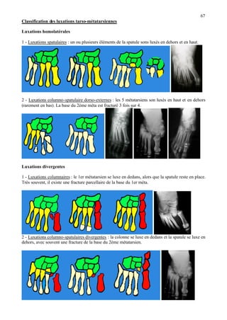 67
Classification des luxations tarso-métatarsiennes
Luxations homolatérales
1 - Luxations spatulaires : un ou plusieurs éléments de la spatule sons luxés en dehors et en haut.
2 - Luxations columno-spatulaire dorso-externes : les 5 métatarsiens son luxés en haut et en dehors
(rarement en bas). La base du 2ème méta est fracturé 3 fois sur 4.
Luxations divergentes
1 - Luxations columnaires : le 1er métatarsien se luxe en dedans, alors que la spatule reste en place.
Très souvent, il existe une fracture parcellaire de la base du 1er méta.
2 - Luxations columno-spatulaires divergentes : la colonne se luxe en dedans et la spatule se luxe en
dehors, avec souvent une fracture de la base du 2ème métatarsien.
 