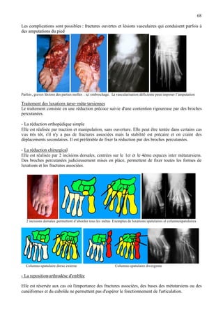 68
Les complications sont possibles : fractures ouvertes et lésions vasculaires qui conduisent parfois à
des amputations du pied
Parfois, graves lésions des parties molles : ici embrochage. La vascularisation déficiente peut imposer l’amputation
Traitement des luxations tarso-méta-tarsiennes
Le traitement consiste en une réduction précoce suivie d'une contention rigoureuse par des broches
percutanées.
- La réduction orthopédique simple
Elle est réalisée par traction et manipulation, sans ouverture. Elle peut être tentée dans certains cas
vus très tôt, s'il n'y a pas de fractures associées mais la stabilité est précaire et on craint des
déplacements secondaires. Il est préférable de fixer la réduction par des broches percutanées.
- La réduction chirurgical
Elle est réalisée par 2 incisions dorsales, centrées sur le 1er et le 4ème espaces inter métatarsiens.
Des broches percutanées judicieusement mises en place, permettent de fixer toutes les formes de
luxations et les fractures associées.
2 incisions dorsales permettent d’aborder tous les métas Exemples de luxations spatulaires et columnospatulaires
Columno-spatulaire dorso externe Columno-spatulaire divergente
- La reposition-arthrodèse d'emblée
Elle est réservée aux cas où l'importance des fractures associées, des bases des métatarsiens ou des
cunéiformes et du cuboïde ne permettent pas d'espérer le fonctionnement de l'articulation.
 