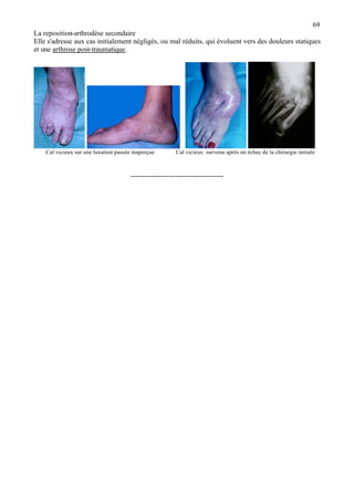 69
La reposition-arthrodèse secondaire
Elle s'adresse aux cas initialement négligés, ou mal réduits, qui évoluent vers des douleurs statiques
et une arthrose post-traumatique.
Cal vicieux sur une luxation passée inaperçue Cal vicieux survenu après un échec de la chirurgie initiale
---------------------------------------
 