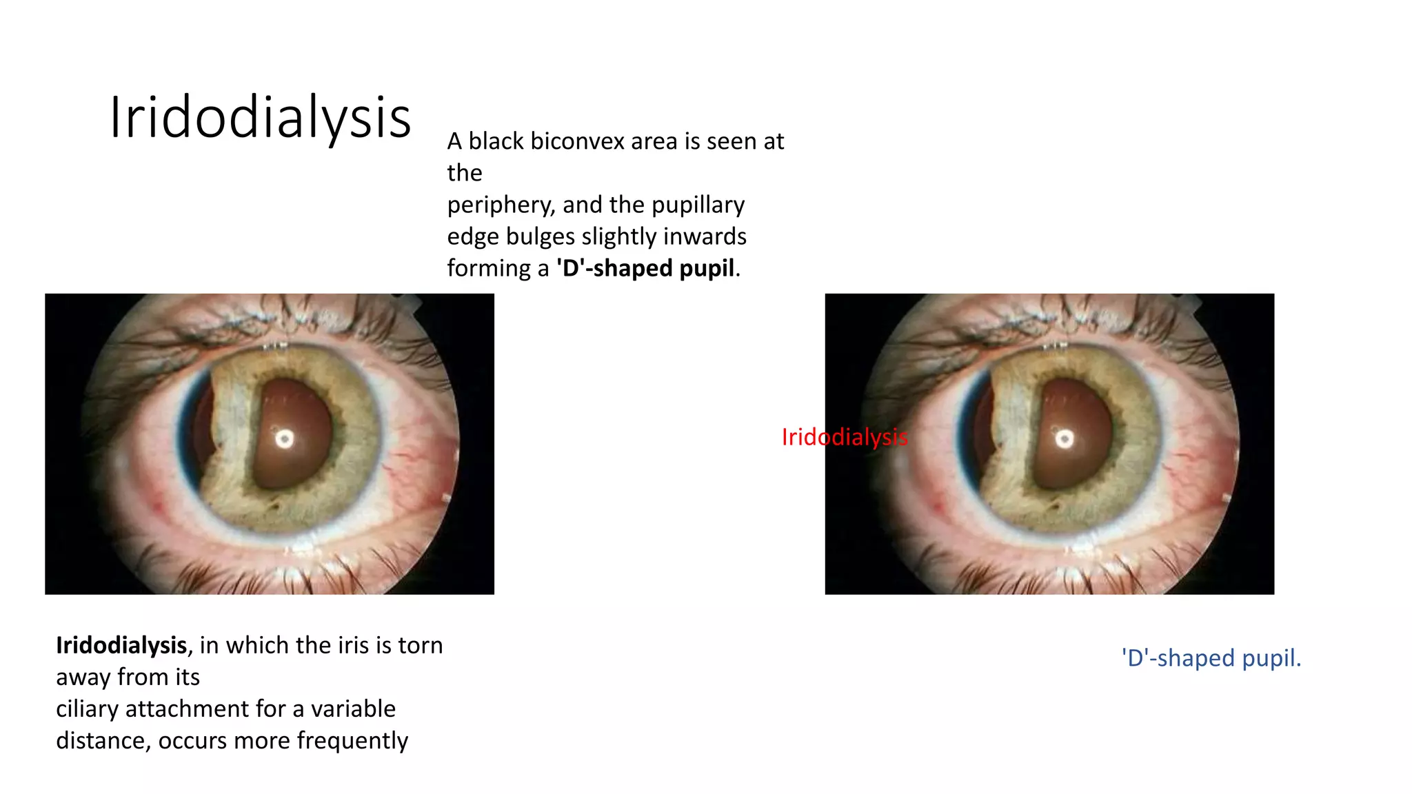 Trauma to eye REVISION NOTES | PPTX