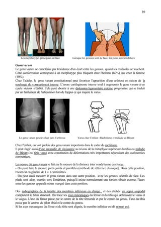 10
Les morphotypes principaux de face Lorsque les genoux sont de face, les pieds sont en dehors
Genu varum
Le genu varum se caractérise par l'existence d'un écart entre les genoux, quand les malléoles se touchent.
Cette conformation correspond à un morphotype plus fréquent chez l'homme (60%) que chez la femme
(40%).
Chez l'adulte, le genu varum constitutionnel peut favoriser l'apparition d'une arthrose en raison de la
surcharge du compartiment interne. L’usure cartilagineuse interne tend à augmenter le genu varum et un
cercle vicieux s’établit. Cela peut aboutir à une distension ligamentaire externe progressive qui se traduit
par un bâillement de l'articulation lors de l'appui ce qui majore le varus.
Le genu varum peut évoluer vers l’arthrose Varus chez l’enfant : Rachitisme et maladie de Blount
Chez l'enfant, on voit parfois des genu varum importants dans le cadre du rachitisme.
Il peut s'agir aussi d'une anomalie de croissance au niveau de la métaphyse supérieure du tibia ou maladie
de Blount (ou tibia vara) avec constitution de déformations très importantes nécessitant des ostéotomies
correctrices.
La mesure du genu varum se fait par la mesure de la distance inter condylienne en charge.
- On peut faire la mesure pieds joints et parallèles (méthode de référence classique). Dans cette position,
l'écart est en général de 1 à 3 centimètres.
- On peut aussi mesurer le genu varum dans une autre position, avec les genoux orientés de face. Les
pieds sont alors tournés vers l'extérieur, puisqu'il existe normalement une torsion tibiale externe, l'écart
entre les genoux apparaît moins marqué dans cette position.
Des radiographies de la totalité des membres inférieurs en charge et des clichés en appui unipodal
complètent le bilan standard. On trace les axes mécaniques du fémur et du tibia qui définissent le varus et
le valgus. L'axe du fémur passe par le centre de la tête fémorale et par le centre du genou. l’axe du tibia
passe par le centres du pilon tibial et le centre du genou.
Si les axes mécaniques du fémur et du tibia sont alignés, le membre inférieur est dit normo axé.
 