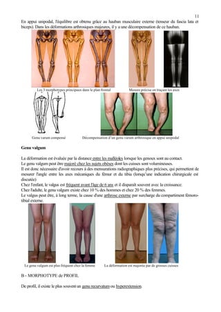 11
En appui unipodal, l'équilibre est obtenu grâce au hauban musculaire externe (tenseur du fascia lata et
biceps). Dans les déformations arthrosiques majeures, il y a une décompensation de ce hauban.
Les 3 morphotypes principaux dans le plan frontal Mesure précise en traçant les axes
Genu varum compensé Décompensation d’un genu varum arthrosique en appui unipodal
Genu valgum
La déformation est évaluée par la distance entre les malléoles lorsque les genoux sont au contact.
Le genu valgum peut être majoré chez les sujets obèses dont les cuisses sont volumineuses.
Il est donc nécessaire d'avoir recours à des mensurations radiographiques plus précises, qui permettent de
mesurer l'angle entre les axes mécaniques du fémur et du tibia (lorsqu’une indication chirurgicale est
discutée)
Chez l'enfant, le valgus est fréquent avant l'âge de 6 ans et il disparaît souvent avec la croissance.
Chez l'adulte, le genu valgum existe chez 10 % des hommes et chez 20 % des femmes.
Le valgus peut être, à long terme, la cause d'une arthrose externe par surcharge du compartiment fémoro-
tibial externe.
Le genu valgum est plus fréquent chez la femme La déformation est majorée par de grosses cuisses
B - MORPHOTYPE de PROFIL
De profil, il existe le plus souvent un genu recurvatum ou hyperextension.
 