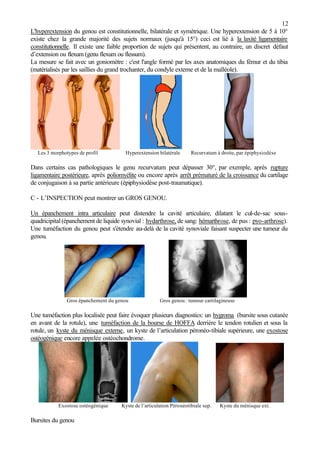 12
L'hyperextension du genou est constitutionnelle, bilatérale et symétrique. Une hyperextension de 5 à 10°
existe chez la grande majorité des sujets normaux (jusqu'à 15°) ceci est lié à la laxité ligamentaire
constitutionnelle. Il existe une faible proportion de sujets qui présentent, au contraire, un discret défaut
d’extension ou flexum (genu flexum ou flessum).
La mesure se fait avec un goniomètre : c'est l'angle formé par les axes anatomiques du fémur et du tibia
(matérialisés par les saillies du grand trochanter, du condyle externe et de la malléole).
Les 3 morphotypes de profil Hyperextension bilatérale Recurvatum à droite, par épiphysiodèse
Dans certains cas pathologiques le genu recurvatum peut dépasser 30°, par exemple, après rupture
ligamentaire postérieure, après poliomyélite ou encore après arrêt prématuré de la croissance du cartilage
de conjugaison à sa partie antérieure (épiphysiodèse post-traumatique).
C - L’INSPECTION peut montrer un GROS GENOU.
Un épanchement intra articulaire peut distendre la cavité articulaire, dilatant le cul-de-sac sous-
quadricipital(épanchement de liquide synovial : hydarthrose, de sang: hémarthrose, de pus : pyo-arthrose).
Une tuméfaction du genou peut s'étendre au-delà de la cavité synoviale faisant suspecter une tumeur du
genou.
Gros épanchement du genou Gros genou : tumeur cartilagineuse
Une tuméfaction plus localisée peut faire évoquer plusieurs diagnostics: un hygroma (bursite sous cutanée
en avant de la rotule), une tuméfaction de la bourse de HOFFA derrière le tendon rotulien et sous la
rotule, un kyste du ménisque externe, un kyste de l’articulation péronéo-tibiale supérieure, une exostose
ostéogénique encore appelée ostéochondrome.
Exostose ostéogénique Kyste de l’articulation Péronéotibiale sup. Kyste du ménisque ext.
Bursites du genou
 