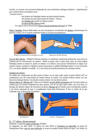 17
résorbé, ou souvent, une succession d'épisodes de crises articulaires analogues (douleurs + épanchement)
que le patient décrit sur plusieurs mois.
L'examen trouve :
. une douleur sur l'interligne interne au point méniscal interne,
. une douleur lors des mouvements de rotation + flexion,
. un "grinding test"positif en rotation externe,
. un signe de Mac Murray positif.
Ces signes sont en faveur d'une lésion verticale postérieure du type I de Trillat
Palper l’interligne fémoro-tibial interne sur tout son pourtour et rechercher une douleur caractéristique à la
pression, surtout vive à la partie antérieure (même si la lésion est postérieure).
Douleur à la pression de l’interligne en avant Manœuvre de Mac Murray
Test de Mac Murray : Pendant la flexion-extension, les déchirures méniscales postérieures sont mises en
évidence par les mouvements de rotation : fléchir le genou, tenir le talon d'une main, de l'autre palper
l'interligne interne et tourner la jambe en dedans et en dehors, puis pousser latéralement en valgus et en
rotation externe, maintenir et étendre le genou doucement en palpant l'interligne interne. Le test est positif,
s'il y a un déclic palpable ou audible : il y a une lésion de la partie postérieure du ménisque interne.
Grinding test (Apley)
On réalise une compression du tibia contre le fémur sur un sujet à plat ventre, le genou fléchi à 90°, en
combinaison avec des mouvements de rotation interne et externe. Une douleur interne oriente vers une
lésion du ménisque interne. Une douleur externe oriente vers une lésion externe.
Flexum discret ou "Blocage fin" il faut savoir dépister un petit déficit d'extension (que l'on peut mettre en
évidence par un examen comparatif des deux genoux, soit sur un sujet à plat ventre, soit sur le dos). Ce
blocage des derniers degrés de l'extension du genou (blocage fin de Généty), peut correspondre, parfois,
à une lésion méniscale de type 3, complètement luxée dans l'échancrure. Il faut se méfier de ne pas
confondre avec un flexum lié à la douleur.
Grinding test Test du « blocage fin »
B - 2ème
tableau : blocage inaugural
Rarement, il s'agit d'un genou en blocage d'emblée.
Le diagnostic est alors facile. Le genou est semi fléchi et l'extension est impossible en raison de
l'interposition d'une anse de seau méniscale en avant du condyle interne (lésion de type 2 de Trillat). Le
 