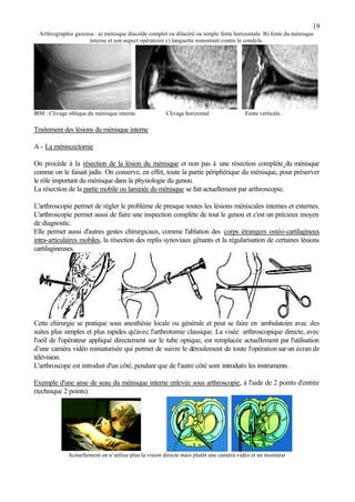 19
Arthrographie gazeuse : a) ménisque discoïde complet ou dilacéré ou simple fente horizontale. B) fente du ménisque
interne et son aspect opératoire c) languette remontant contre le condyle.
IRM : Clivage oblique du ménisque interne Clivage horizontal Fente verticale.
Traitement des lésions du ménisque interne
A - La méniscectomie
On procède à la résection de la lésion du ménisque et non pas à une résection complète du ménisque
comme on le faisait jadis. On conserve, en effet, toute la partie périphérique du ménisque, pour préserver
le rôle important du ménisque dans la physiologie du genou.
La résection de la partie mobile ou laminée du ménisque se fait actuellement par arthroscopie.
L'arthroscopie permet de régler le problème de presque toutes les lésions méniscales internes et externes.
L'arthroscopie permet aussi de faire une inspection complète de tout le genou et c'est un précieux moyen
de diagnostic.
Elle permet aussi d'autres gestes chirurgicaux, comme l'ablation des corps étrangers ostéo-cartilagineux
intra-articulaires mobiles, la résection des replis synoviaux gênants et la régularisation de certaines lésions
cartilagineuses.
Cette chirurgie se pratique sous anesthésie locale ou générale et peut se faire en ambulatoire avec des
suites plus simples et plus rapides qu'avec l'arthrotomie classique. La visée arthroscopique directe, avec
l'oeil de l'opérateur appliqué directement sur le tube optique, est remplacée actuellement par l'utilisation
d’une caméra vidéo miniaturisée qui permet de suivre le déroulement de toute l'opérationsur un écran de
télévision.
L'arthroscope est introduit d'un côté, pendant que de l'autre côté sont introduits les instruments .
Exemple d'une anse de seau du ménisque interne enlevée sous arthroscopie, à l'aide de 2 points d'entrée
(technique 2 points).
Actuellement on n’utilise plus la vision directe mais plutôt une caméra vidéo et un moniteur
 
