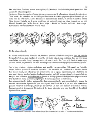20
Des instruments fins et de plus en plus sophistiqués, permettent de réaliser des gestes opératoires, dans
des cavités articulaires petites.
1er temps : L'anse de seau du ménisque interne est reconnue par le tube optique, introduit du coté externe.
2ème temps : La bandelette est mobilisée par l'instrument ou crochet palpateur qui est introduit par un
autre trou, du coté interne. L'anse de seau doit être repoussée, d'abord, en arrière du condyle interne.
3ème temps : L'attache sur la corne postérieure est sectionnée avec une pince coupante ou un petit
bistouri, introduit par l'orifice interne. 4ème temps : Section de l'attache antérieure. 5ème temps :
Extraction de la bandelette libérée avec un pince.
B - La suture méniscale
La suture d'une déchirure méniscale est possible à plusieurs conditions : lorsque la fente est verticale,
lorsqu'elle n'est pas trop étendue et lorsqu'elle est située près du mur postérieur dans une zone assez
vascularisée (zone dite "rouge", par opposition à la zone centrale, dite "blanche"). La cicatrisation, après
de telles sutures, est possible et elle a été prouvée par des contrôles arthrographiques et arthroscopiques.
Sur le plan technique, plusieurs techniques sont possibles : on peut utiliser 2 fils montés sur 2 aiguilles
droites, qui sont poussées à travers un tube creux. Elles traversent les 2 versants de la brèche à suturer.
Les fils sont noués, soit à l'extérieur (en prenant appui sur la capsule ligamentaire), soit à l'intérieur. On
peut aussi faire un nœud au bout du fil et lorsqu'on va tirer sur le fil on va appliquer les berges de la fente.
On peut aussi utiliser de petites broches en Tfaites en acide polylactique biodégradable qui permettent de
fixer d'une façon stable les lésions périphériques du ménisque pendant la cicatrisation.
Les sutures méniscales isolées sont possibles. Les sutures méniscales sont surtout indiquées lorsque l'on
fait une reconstruction ligamentaire pour une rupture associée du LCA. Il est alors très important de
pouvoir conserver un ménisque, plutôt que de l'enlever. On aura une meilleure évolution du nouveau
ligament croisé et, inversement, l'évolution de la lésion méniscale sera plus favorable si la stabilité
ligamentaire est rétablie.
Technique des sutures des fentes méniscales par des fils passés en U et noués à l’extérieur ou à l’intérieur
 