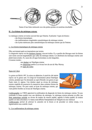 21
Suture d’une fente méniscale avec des petites pointes en matériau résorbable
II – Les lésions du ménisque externe
Le ménisque externe est moins souvent lésé que l'interne. Il présente 3 types de lésions :
- des lésions traumatiques
- des malformations congénitales caractéristiques du ménisque externe
- des kystes méniscaux plus caractéristiques du ménisque externe que de l'interne.
a - Les lésions traumatiques du ménisque externe
Elles surviennent après un traumatisme par torsion.
Le diagnostic repose sur des douleurs externes, souvent isolées. Il y a parfois des blocages mais les lésions
sont moins souvent longitudinales que celles du ménisque interne. Les déchirures du ménisque externe sont
plutôt transversales. Il y aussi des clivages horizontaux ou des languettes.
L'examen montre :
. une douleur sur l'interligne externe
. un claquement parfois à ce niveau lors du test de Mac Murray
. un signe de Cabot.
Signe de Cabot
Le genou est fléchi à 90°, la cuisse en abduction, le pied du côté atteint
repose sur le genou sain. Un doigt de l'examinateur presse l'interligne
externe, pendant que l'on demande au sujet d'étendre son genou et que
l'autre main s'y oppose. Une douleur aiguë au niveau du ménisque
externe empêche de poursuivre la manœuvre dans certaines lésions du
ménisque externe. On peut sentir un kyste du ménisque externe, qui
vient parfois bomber au niveau de l'interligne externe.
L'arthrographie ou l’IRM apportent la confirmation du diagnostic de lésion du ménisque externe. Ne pas
confondre le hiatus poplité avec une déchirure du ménisque. Le ménisque externe présente en effet, une
fente anatomique normale au niveau du tendon du muscle poplité, appelée le hiatus poplité (le tendon
poplité est intra-articulaire). Ce hiatus rend difficile l'interprétation de l'intégrité du mur méniscal.
L'arthroscopie permet de préciser le caractère de la lésion et de procéder en même temps, à la
régularisation sous contrôle visuel.
b - Les malformations du ménisque externe
 