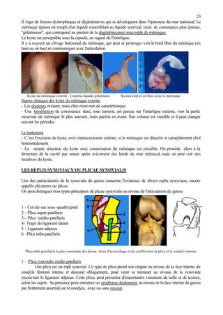 23
Il s'agit de lésions dystrophiques et dégénératives qui se développent dans l'épaisseur du mur méniscal. Le
ménisque épaissi est rempli d'un liquide ressemblant au liquide synovial, mais de consistance plus épaisse,
"gélatineuse", qui correspond au produit de la dégénérescence muccoïde du ménisque.
Le kyste est perceptible sous la capsule, en regard de l'interligne.
Il y a souvent un clivage horizontal du ménisque, qui peut se prolonger vers le bord libre du ménisque (en
haut ou en bas) et communiquer avec l'articulation.
Kyste du ménisque externe Contenu liquide gélatineux Kystes enlevé en bloc avec le ménisque
Signes cliniques des kytes du ménisque externe
- Les douleurs existent, mais elles n'ont rien de caractéristique.
- Une tuméfaction de consistance dure, sous tension, est perçue sur l'interligne externe, vers la partie
moyenne du ménisque le plus souvent, mais parfois en avant. Son volume est variable et il peut changer
suivant les périodes.
Le traitement
- C’est l'excision du kyste, avec méniscectomie externe, si le ménisque est dilacéré et complètement clivé
horizontalement.
- La simple résection du kyste avec conservation du ménisque est possible. On procède alors à la
fermeture de la cavité par suture après avivement des bords du mur méniscal, mais on peut voir des
récidives du kyste.
LES REPLIS SYNOVIAUX OU PLICAE SYNOVIALIS
Une des particularités de la synoviale du genou concerne l'existence de divers replis synoviaux, encore
appelés plicatures ou plicae.
On peut distinguer trois types principaux de plicae synovialis au niveau de l'articulation du genou
1 - Cul-de-sac sous-quadricipital
2 - Plica supra-patellaris
3 - Plica médio-patellaris
4- Trajet du ligament latéral
5 - Ligament adipeux
6 –Plica infra-patellaris
Plica infra-patellaris la plus constante des plicae. Zone d'accrochage et de conflit entre la plica et le condyle interne
1 – Plica synovialis medio patellaris
Une plica est un repli synovial. Ce type de plica prend son origine au niveau de la face interne du
condyle fémoral interne et descend obliquement, pour venir se terminer au niveau de la synoviale
recouvrant le ligament adipeux. Cette plica, peut présenter d'importantes variations de taille et de texture,
selon les sujets. Sa présence peut entraîner un syndrome douloureux au niveau de la face interne du genou
par frottement anormal sur le condyle, avec ou sans ressaut.
 