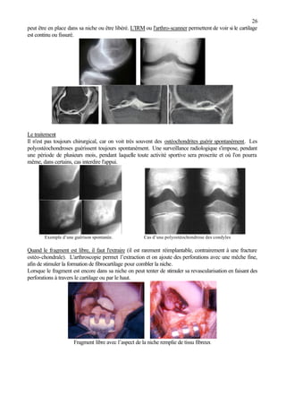 26
peut être en place dans sa niche ou être libéré. L'IRM ou l'arthro-scanner permettent de voir si le cartilage
est continu ou fissuré.
Le traitement
Il n'est pas toujours chirurgical, car on voit très souvent des ostéochondrites guérir spontanément. Les
polyostéochondroses guérissent toujours spontanément. Une surveillance radiologique s'impose, pendant
une période de plusieurs mois, pendant laquelle toute activité sportive sera proscrite et où l'on pourra
même, dans certains, cas interdire l'appui.
Exemple d’une guérison spontanée. Cas d’une polyostéochondrose des condyles
Quand le fragment est libre, il faut l'extraire (il est rarement réimplantable, contrairement à une fracture
ostéo-chondrale). L'arthroscopie permet l’extraction et on ajoute des perforations avec une mêche fine,
afin de stimuler la formation de fibrocartilage pour combler la niche.
Lorsque le fragment est encore dans sa niche on peut tenter de stimuler sa revascularisation en faisant des
perforations à travers le cartilage ou par le haut.
Fragment libre avec l’aspect de la niche remplie de tissu fibreux
 
