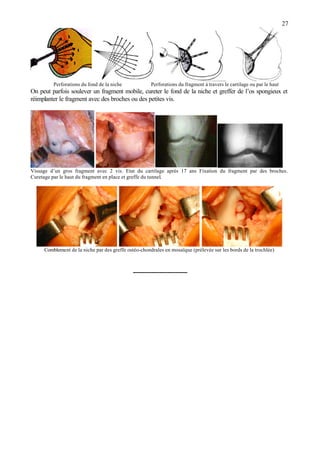 27
Perforations du fond de la niche Perforations du fragment à travers le cartilage ou par le haut
On peut parfois soulever un fragment mobile, cureter le fond de la niche et greffer de l’os spongieux et
réimplanter le fragment avec des broches ou des petites vis.
Vissage d’un gros fragment avec 2 vis. Etat du cartilage après 17 ans Fixation du fragment par des broches.
Curetage par le haut du fragment en place et greffe du tunnel.
Comblement de la niche par des greffe ostéo-chondrales en mosaïque (prélevée sur les bords de la trochlée)
---------------------------
 