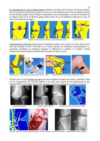31
Les traumatismes en varus et rotation interne entraînent une rupture du LCA (puis des lésions externes).
On voit souvent des arrachements osseux au niveau de la tête du péroné (LLE) avec possibilité de lésion
du nerf sciatique poplité externe. D'autres arrachements osseux sont possibles, au niveau de l'insertion sur
le condyle externe et sur le rebord du plateau tibial externe. En cas de bâillement important en varus, les
deux croisés peuvent se rompre
Rupture du LCA Rupture des formations externes ou arrachements osseux Lésion du SPE
L'hyperextension forcée lèse le LCA (puis les ligaments externes et les coques). Lors d'un shoot dans le
vide, par exemple, le LCA vient buter sur le rebord antérieur de l'échancrure intercondylienne. La
contraction simultanée du quadriceps augmente la subluxation et contribue à la rupture. Lorsque
l'échancrure est étroite (facteur constitutionnel favorisant) le risque est accru.
Rupture du LCA par Hyperextension (shoot dans le vide) Rupture du LCP (accident du tableau de bord)
On peut aussi voir des luxations du genou avec perte complète de contact des surfaces articulaires. Dans
ces cas exceptionnels, les vaisseaux poplités et les nerfs sont menacés lors du déplacement ou par
étirement (SPE). Les luxations peuvent être postérieures mais aussi antérieures et externes ou internes.
Luxation antérieure Luxation antéro-interne Lésions vasculo-nerveuses possibles
Lésions externes avec étirement et paralysie du SPE (œdème et echymose du nerf) Arrachements osseux externes
 
