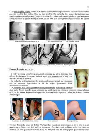 32
- Les radiographies simples de face et de profil sont indispensables pour éliminer l'existence d'une fracture
associée possible d'un plateau tibial ou d'un condyle. On recherche des images d'arrachement des
insertions osseuses des ligaments (interne, externe ou des croisés sur le massif spinal) qui représentent une
forme plus facile à réparer chirurgicalement, car on peut fixer les fragments avec des vis ou des agrafes
vissées.
Arrachements de l’insertion du LCA de l’insertion du LCP du ligament interne
L’IRM met en évidence les lésions ligamentaires, méniscales et cartilagineuses
Examendes entorses graves
- Il peut y avoir une hémarthrose rapidement constituée, qui est un bon signe pour
affirmer le diagnostic de rupture, mais ce signe peut manquer car le sang peut
diffuser à travers les brèches.
- On recherche systématiquement les points douloureux éventuels qui renseignent
sur les insertions ligamentaires et sur les trajets ligamentaires lésés.
Hémarthrose et ecchymoses
- On recherche de la laxité ligamentaire en valgus et en varus en extension complète
et en légère flexion. Quand il existe nettement une laxité interne ou externe en extension, on peut affirmer
qu’il y a des lésions périphériques importantes de ce côté et les ligaments croisés ont de fortes chances
d'être rompus.
Recherche de la laxité interne et externe Tiroir antérieur Tiroir postérrieur
Tiroir en flexion : Le genou est fléchi à 90°, le pied est bloqué par l'examinateur, on tire le tibia en avant
pour mettre en évidence un tiroir antérieur (rupture du LCA). On pousse le tibia en arrière pour mettre en
évidence un tiroir postérieur (rupture du LCP). On peut faire des radiographies pour mesurer avec
 
