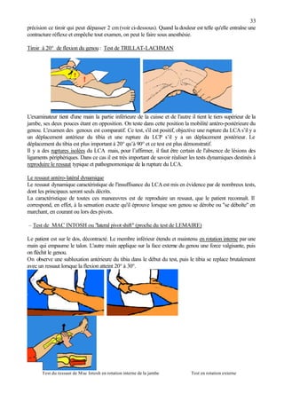33
précision ce tiroir qui peut dépasser 2 cm (voir ci-dessous). Quand la douleur est telle qu'elle entraîne une
contracture réflexe et empêche tout examen, on peut le faire sous anesthésie.
Tiroir à 20° de flexion du genou : Test de TRILLAT-LACHMAN
L'examinateur tient d'une main la partie inférieure de la cuisse et de l'autre il tient le tiers supérieur de la
jambe, ses deux pouces étant en opposition. On teste dans cette position la mobilité antéro-postérieure du
genou. L'examen des genoux est comparatif. Ce test, s'il est positif, objective une rupture du LCA s’il y a
un déplacement antérieur du tibia et une rupture du LCP s’il y a un déplacement postérieur. Le
déplacement du tibia est plus important à 20° qu’à 90° et ce test est plus démonstratif.
Il y a des ruptures isolées du LCA mais, pour l’affirmer, il faut être certain de l'absence de lésions des
ligaments périphériques. Dans ce cas il est très important de savoir réaliser les tests dynamiques destinés à
reproduire le ressaut typique et pathognomonique de la rupture du LCA.
Le ressaut antéro-latéral dynamique
Le ressaut dynamique caractéristique de l'insuffisance du LCA est mis en évidence par de nombreux tests,
dont les principaux seront seuls décrits.
La caractéristique de toutes ces manœuvres est de reproduire un ressaut, que le patient reconnaît. Il
correspond, en effet, à la sensation exacte qu'il éprouve lorsque son genou se dérobe ou "se déboîte" en
marchant, en courant ou lors des pivots.
– Test de MAC INTOSH ou "lateral pivot shift" (proche du test de LEMAIRE)
Le patient est sur le dos, décontracté. Le membre inférieur étendu et maintenu en rotation interne par une
main qui empaume le talon. L'autre main applique sur la face externe du genou une force valgisante, puis
on fléchit le genou.
On observe une subluxation antérieure du tibia dans le début du test, puis le tibia se replace brutalement
avec un ressaut lorsque la flexion atteint 20° à 30°.
Test du ressaut de Mac Intosh en rotation interne de la jambe Test en rotation externe
 