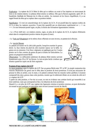 34
Explication : La rupture du LCA libère le tibia qui se subluxe en avant si l'on imprime un mouvement de
tiroir et de rotation interne. Le plateau tibial externe se subluxe. Dès que la flexion augmente, après 20°, la
bandelette iliotibiale de Maissiat tire le tibia en arrière. Au moment où les forces s'équilibrent, il y a un
rappel brutal du tibia qui se replace dans sa position initiale.
Signification : Ce test est caractéristique de la rupture du LCA. Il est positif dans les ruptures isolées du
LCA et dans les ruptures associées. Il peut être quantifié par un observateur expérimenté en +, ++ ou
+++. Un test fortement positif signe, en plus, la lésion des formations ligamentaires externes.
- Le « Pivot shift test » en rotation externe, signe, en plus de la rupture du LCA, la rupture d'éléments
situés dans le compartiment postéro-interne du genou (Losee).
- Le "Jerk test"(Hughston) est la même chose effectuée en sens inverse, en partant de la flexion.
- Le test de Slocum
Le patient est tourné sur le côté (côté gauche, lorsqu'on examine le genou
droit). La face interne du pied du côté examiné repose sur la table. Le
genou est en extension. Une force valgisante est appliquée par les 2 mains
posées sur la face externe du genou de part et d'autre de l'articulation. Le
genou est progressivement fléchi.
Observation : La subluxation antérieure du plateau tibial externe survient
brutalement entre 20 et 30° de flexion. Le test est plus facile à réaliser que
d'autres quand les sujets ont de forts segments.
Examen d’une rupture du LCP
Le tiroir postérieur signe la rupture du LCP. Sur un genou fléchi entre 70° et 90°, la simple contraction des
muscles fléchisseurs du genou met le tibia dans la position de tiroir postérieur. Il n'est pas nécessaire de
pousser le tibia en arrière, avec la main, si le patient contracte bien les muscles ischio-jambiers. L'examen
comparatif des deux genoux dans cette position, montre que la tubérosité tibiale est en retrait du côté où il
y a rupture du LCP.
A partir de cette position, si l'on tire en avant, on met en évidence une certaine laxité qui ressemble à un
tiroir antérieur, mais qui correspond en fait, à la réduction du tiroir postérieur.
Quand il y a en plus du LCP, une rupture des ligaments externes et postéro externes, on peut déclencher
un ressaut un peu analogue au précédent mais inversé (ressaut inversé de Jakob)
Le LCP vu de l’arrière LCP vu sur une coupe sagittale
Tiroir postérieur à 90° Tiroir mis en évidence par la contraction des ischio-jambiers
MESURE DE LA LAXITÉ LIGAMENTAIRE
 