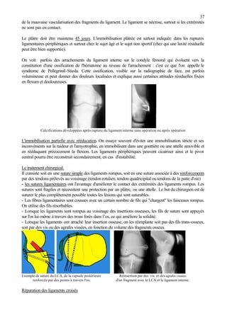 37
de la mauvaise vascularisation des fragments du ligament. Le ligament se nécrose, surtout si les extrémités
ne sont pas en contact.
Le plâtre doit être maintenu 45 jours. L'immobilisation plâtrée est surtout indiquée dans les ruptures
ligamentaires périphériques et surtout chez le sujet âgé et le sujet non sportif (chez qui une laxité résiduelle
peut être bien supportée).
On voit parfois des arrachements du ligament interne sur le condyle fémoral qui évoluent vers la
constitution d'une ossification de l'hématome au niveau de l'arrachement : c'est ce que l'on appelle le
syndrome de PellegriniI-Stieda. Cette ossification, visible sur la radiographie de face, est parfois
volumineuse et peut donner des douleurs localisées et explique aussi certaines attitudes résiduelles fixées
en flexum et douloureuses.
Calcifications développées après rupture du ligament interne sans opération ou après opération
L'immobilisation partielle avec rééducation. On essaye souvent d'éviter une immobilisation stricte et ses
inconvénients sur la raideur et l'amyotrophie, en immobilisant dans une gouttière ou une attelle amovible et
en rééduquant précocement la flexion. Les ligaments périphériques peuvent cicatriser ainsi et le pivot
central pourra être reconstruit secondairement, en cas d'instabilité.
Le traitement chirurgical.
Il consiste soit en une suture simple des ligaments rompus, soit en une suture associée à des renforcements
par des tendons prélevés au voisinage (tendon rotulien, tendon quadricipital ou tendons de la patte d'oie)
- les sutures ligamentaires ont l'avantage d'améliorer le contact des extrémités des ligaments rompus. Les
sutures sont fragiles et nécessitent une protection par un plâtre, ou une attelle. Le but du chirurgien est de
suturer le plus complètement possible toutes les lésions qui sont suturables.
- Les fibres ligamentaires sont cousues avec un certain nombre de fils qui "chargent" les faisceaux rompus.
On utilise des fils résorbables.
- Lorsque les ligaments sont rompus au voisinage des insertions osseuses, les fils de suture sont appuyés
sur l'os lui-même à travers des trous forés dans l’os, ce qui améliore la solidité.
- Lorsque les ligaments ont arraché leur insertion osseuse, on les réimplante soit pas des fils trans-osseux,
soit par des vis ou des agrafes vissées, en fonction du volume des fragments osseux.
Exemple de suture du LCA, de la capsule postérieure Réinsertion par des vis et des agrafes vissées.
renforcée par des points à travers l'os. d'un fragment avec le LCA et le ligament interne
Réparation des ligaments croisés
 
