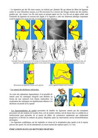 38
- La réparation par des fils trans-osseux est réalisée par plusieurs fils qui attirent les fibres du ligament
contre la zone d'insertion osseuse. Les fils traversent l'os à travers des forages réalisés par des mèches,
guidées par des viseurs. Les fils sont noués en prenant appui sur l'os. Les fils ont un appui solide mais
l'extrémité du ligament est souvent très fragile et le ligament a subi une distension plastique importante
avant la rupture et à cause de cela, la cicatrisation reste aléatoire.
Exemple d'une réparation du LCA en bas et en haut du LCP en bas et en haut, du biceps en bas, du fascia-lata, du
ligament externe, du tendon du poplité et du tendon du biceps. Réparation complexe du compartiment externe
Réinsertion du ligament externe sur le péroné et du Ligament interne sur le condyle
- Les sutures des déchirures méniscales.
Au cours des réparations ligamentaires, il est possible de
suturer aussi les ménisques lorsqu'ils sont déchirés au
niveau du mur méniscal (voir lésions méniscales). La
cicatrisation des ménisques est régulièrement obtenue si la
déchirure est proche de la capsule
- Les ligamentoplasties de renfort permettent de doubler les ligaments suturés par des transplants
provenant soit des tendons de la patte d'oie, soit du tendon rotulien, soit du fascia-lata. La solidité de ce
renforcement peut permettre de se passer de plâtre, de commencer rapidement une rééducation
progressive et d'éviter les raideurs du genou, fréquentes après les interventions suivies d'immobilisations
prolongées.
- Les ligaments synthétiques ont été implantés en raison de la récupération plus rapide et de la reprise
précoce des sports. Ils ont été abandonnés en raison surtout des ruptures après 2 à 3 ans.
INDICATIONS DANS LES RUPTURES FRAÎCHES
 