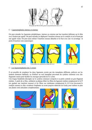 43
Procédé de MULLER, pour la reconstruction du L.C.P
C - Ligamentoplasties internes et externes
On peut retendre les ligaments périphériques internes ou externes par leur insertion inférieure sur le tibia
avec fixation par agrafe. On peut retendre en déplaçant l’insertion osseuse sur le condyle et en la fixant par
une agrafe vissée. On peut aussi enfouir l’insertion osseuse détachée et la fixer avec une vis (avantage : le
point d’insertion reste anatomique)
Retension en bas du LLI 2 procédés de retention en haut du LLI Plastie externe double
C - Les ligamentoplasties des 2 croisés
Il est possible de remplacer les deux ligaments croisés par des transplants différents, prélevés sur les
tendons donneurs habituels, ou d'utiliser un seul transplant provenant du système extenseur avec des
fragments osseux pour faciliter les ancrages (procédé de JL Lerat).
Une longue bandelette découpée sur le système extenseur comporte à sa partie centrale un gros fragment
rotulien. A partir de ce bloc, solidarisé au plateau tibial, les fibres du ligament rotulien remplaceront le LCP
(en gardant une insertion osseuse) et les fibres sus rotuliennes remplaceront le LCA (en traversant le
condyle externe) et elles viendront s'implanter en avant jusqu'au tubercule de Gerdy pour réaliser en plus
une plastie extra-articulaire complémentaire.
Principe de la reconstruction des 2 croisés avec une partie des tendons rotulien et quadricipital et plasties périphériques
-------------------------------------------------------
 