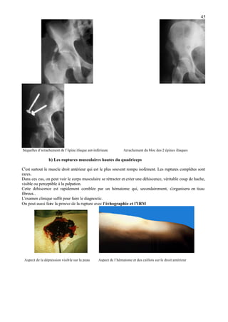 45
Séquelles d’arrachement de l’épine iliaque ant-inférieure Arrachement du bloc des 2 épines iliaques
b) Les ruptures musculaires hautes du quadriceps
C'est surtout le muscle droit antérieur qui est le plus souvent rompu isolément. Les ruptures complètes sont
rares.
Dans ces cas, on peut voir le corps musculaire se rétracter et créer une déhiscence, véritable coup de hache,
visible ou perceptible à la palpation.
Cette déhiscence est rapidement comblée par un hématome qui, secondairement, s'organisera en tissu
fibreux..
L'examen clinique suffit pour faire le diagnostic.
On peut aussi faire la preuve de la rupture avec l'échographie et l’IRM
Aspect de la dépression visible sur la peau Aspect de l’hématome et des caillots sur le droit antérieur
 