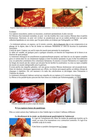 46
Rupture importante aspect de l’hématome et de la dilacération Autre cas de rupture plus proche du tendon
Evolution :
Ces ruptures musculaires, petites ou moyennes, cicatrisent spontanément, le plus souvent.
En l'absence d'un traitement immédiat, on peut voir des troubles liés à une cicatrice fibreuse dure et parfois
douloureuse. Rarement, on peut voir évoluer un pseudo-kyste qui est un nodule profond avec une petite
collection liquidienne en son centre, que l'on peut mettre en évidence par l'échographie ou l’IRM.
- Le traitement précoce, en urgence, sur le terrain, consiste, dès le diagnostic fait, en une compression et un
glaçage de la région, dans le but de limiter au minimum l'hématome et ainsi de favoriser la cicatrisation
musculaire.
L'arrêt du sport s’impose, car seul le repos du muscle peut permettre la cicatrisation.
Le délai est variable, de quelques jours à quelques semaines, en fonction de l'importance de la lésion et en
fonction du sport pratiqué.
Le traitement chirurgical est actuellement exceptionnellement proposé, sauf dans les cas de rupture complète
grave et surtout dans les cas initialement négligés et dont l'évolution spontanée n'a pas évolué favorablement
avec en particulier constitution d'un volumineux hématome. Il consiste à évacuer l'hématome et à rapprocher
les berges du muscle par des sutures qui ont pour but de faciliter la cicatrisation. La mise au repos complète
du muscle est ensuite indispensable pour la guérison.
Il existe parfois des séquelles gênantes, soit une grosse cicatrice fibreuse douloureuse soit un pseudo-kyste.
Outre les douleurs chroniques apparaissant aux efforts, ces lésions provoquent parfois un tableau clinique de
claquages à répétition. On voit rarement à la radio des calcifications se développer dans l’hématome à
l’intérieur du muscle.
Le traitement chirurgical s'adresse surtout aux séquelles de ces ruptures et il consiste à les réséquer.
La fibrose et les pseudo-kystes peuvent être bien mises en évidence par l'échotomographie et l’IRM.
Fibrose cicatricielle en plein corps du muscle Pseudokyste Calcifications
B) Les ruptures basses du quadriceps
Elles se voient surtout chez l'adolescent et chez l'adulte âgé et revêtent 2 tableaux différents:
Le décollement de la rotule ou décalottement quadricipital de l'adolescent
Il s’agit de l’arrachement des fibres du tendon du quadriceps insérées sur la
rotule, au cours d’un traumatisme avec contraction contrariée. Il s’agit d’un
véritable scalp de la rotule.
Cette lésion se produit classiquement en 3 temps :
 