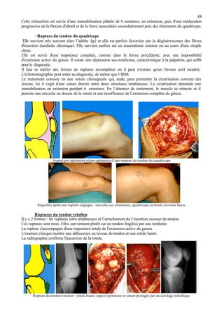 48
Cette réinsertion est suivie d'une immobilisation plâtrée de 6 semaines, en extension, puis d'une rééducation
progressive de la flexion d'abord et de la force musculaire secondairement puis des étirements du quadriceps.
- Rupture du tendon du quadriceps
Elle survient très souvent chez l’adulte âgé et elle est parfois favorisée par la dégénérescence des fibres
d'insertion (tendinite chronique). Elle survient parfois sur un traumatisme minime ou au cours d'une simple
chute.
Elle est suivie d'une impotence complète, comme dans la forme précédente, avec une impossibilité
d'extension active du genou. Il existe une dépression sus-rotulienne, caractéristique à la palpation, qui suffit
pour le diagnostic.
Il faut se méfier des formes de ruptures incomplètes où il peut n'exister qu'un flexum actif modéré.
L'échotomographie peut aider au diagnosti,c de même que l’IRM.
Le traitement consiste en une suture chirurgicale qui, seule, peut permettre la cicatrisation correcte des
lésions. Ici il s'agit d'une suture directe entre deux structures tendineuses. La cicatrisation demande une
immobilisation en extension pendant 6 semaines. En l’absence de traitement, le muscle se rétracte et il
persiste une encoche au dessus de la rotule et une insuffisance de l’extension complète du genou.
Aspect pré opératoire et per opératoire d’une rupture du tendon du quadriceps
Séquelles après une rupture négligée : encoche sus rotulienne, quadriceps en boule et rotule basse
Ruptures du tendon rotulien
Il y a 2 formes : les ruptures intra tendineuses et l’arrachement de l’insertion osseuse du tendon.
Ces ruptures sont rares. Elles surviennent plutôt sur un tendon fragilisé par une tendinite.
La rupture s'accompagne d'une impotence totale de l'extension active du genou.
L'examen clinique montre une déhiscence au niveau du tendon et une rotule haute.
La radiographie confirme l'ascension de la rotule.
Rupture du tendon rotulien : rotule haute, aspest opératoire et suture protégée par un cerclage métallique
 