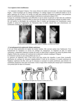 49
- Les ruptures intra tendineuses
- Le traitement chirurgical s'impose. Une suture directe du tendon est nécessaire. La suture étant toujours
fragile, il faut la protéger par un cadrage métallique. Ce cadrage s'appuie sur la tubérosité tibiale et sur la
partie supérieure de la rotule et le serrage est réglé pour maintenir la longueur du tendon. Cette protection
permet la mobilisation douce du genou pendant la période de cicatrisation (jusqu’à 90°).
Lorsque les extrémités tendineuses sont effilochées et que la suture ne peut pas se faire dans des conditions
mécaniques acceptables, on peut doubler la suture par une plastie de renforcement utilisant un tendon voisin.
On voit parfois se développer des ossifications dans le tendon qui témoignent de l’arrachement osseux
possible et surtout de l’organisation de l’hématome dans le tendon. Quand elles sont volumineuses, ces
ossifications simulent une deuxième rotule.
Ossifications intra tendineuses après ruptures négligées. La rotule reste haute
- L'arrachement de la tubérosité tibiale antérieure
C’est une forme particulière de rupture du tendon rotulien. Elle survient surtout chez l'adolescent. C'est
l'arrachement de l'apophyse au niveau du cartilage de conjugaison. Le fragment est plus ou moins
volumineux, comprenant seulement la pointe du rostre ou allant jusqu’à emporter une partie du plateau tibial
(Ogden). Parfois des avulsions de l’extrémité de la tubérosité viennent compliquer l’Osgood.
Le traitement consiste en une ostéosynthèse par une vis.
La guérison est habituelle mais il faut savoir qu'il peut exister des séquelles à cause d'une éventuelle
stérilisation du cartilage de croissance (épiphysiodèse). L'arrêt de la croissance à la partie antérieure de
l'épiphyse supérieure du tibia, alors que la croissance se poursuit à la partie postérieure, peut aboutir à la
constitution progressive d'un genu recurvatum. Celui-ci risque d'être d'autant plus marqué que le traumatisme
s'est produit plus tôt dans la croissance.
Classification de Ogden des fractures avulsion de la TTA
Tout arrachement de la tubérosité tibiale doit être fixé chirurgicalement (en ménageant la plaque conjugale)
 