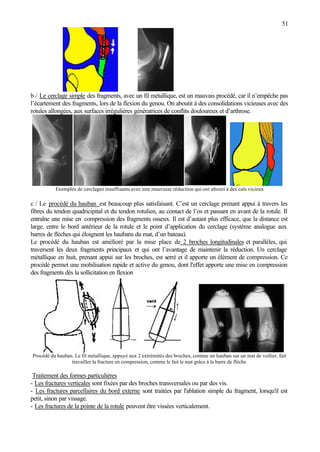 51
b / Le cerclage simple des fragments, avec un fil métallique, est un mauvais procédé, car il n’empêche pas
l’écartement des fragments, lors de la flexion du genou. On aboutit à des consolidations vicieuses avec des
rotules allongées, aux surfaces irrégulières génératrices de conflits douloureux et d’arthrose.
Exemples de cerclages insuffisants avec une mauvaise réduction qui ont abouti à des cals vicieux
c / Le procédé du hauban est beaucoup plus satisfaisant. C’est un cerclage prenant appui à travers les
fibres du tendon quadricipital et du tendon rotulien, au contact de l’os et passant en avant de la rotule. Il
entraîne une mise en compression des fragments osseux. Il est d’autant plus efficace, que la distance est
large, entre le bord antérieur de la rotule et le point d’application du cerclage (système analogue aux
barres de flèches qui éloignent les haubans du mat, d’un bateau).
Le procédé du hauban est amélioré par la mise place de 2 broches longitudinales et parallèles, qui
traversent les deux fragments principaux et qui ont l’avantage de maintenir la réduction. Un cerclage
métallique en huit, prenant appui sur les broches, est serré et il apporte un élément de compression. Ce
procédé permet une mobilisation rapide et active du genou, dont l'effet apporte une mise en compression
des fragments dès la sollicitation en flexion
Procédé du hauban. Le fil métallique, appuyé aux 2 extrémités des broches, comme un hauban sur un mat de voilier, fait
travailler la fracture en compression, comme le fait le mat grâce à la barre de flèche
Traitement des formes particulières
- Les fractures verticales sont fixées par des broches transversales ou par des vis.
- Les fractures parcellaires du bord externe sont traitées par l'ablation simple du fragment, lorsqu'il est
petit, sinon par vissage.
- Les fractures de la pointe de la rotule peuvent être vissées verticalement.
 