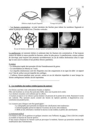 52
Ablation simple du petit fragment Vissage de la pointe
- Les fractures comminutives : on peut introduire des broches pour réduire les nombreux fragments et
utiliser le principe du hauban avec 2 broches verticales.
En cas de fractures comminutives, on peut ajouter au hauban vertical, un cadrage transversal
La patellectomie est rarement réalisée et seulement dans les fractures très comminutives. Il faut toujours
essayer de réduire le mieux possible les fractures, même les plus graves. La patellectomie, comme solution
de sauvetage, peut toujours être proposée secondairement, en cas de raideur douloureuse (chez le sujet
âgé on aura aussi la solution d’une prothèse fémoro-patellaire).
Evolution
- La rééducation rapide doit permettre d'éviter l'enraidissement du genou.
- La consolidation est obtenue en 3 mois.
- Les séquelles douloureuses sont très fréquentes avec des craquements et un signe du rabot en rapport
avec l’état de surface souvent imparfait des cartilages.
- L'arthrose fémoro-patellaire peut survenir, surtout en cas de réduction imparfaite et aussi lorsque les
lésions cartilagineuses initiales ont été importantes.
_______________________________
2 – Les tendinites du tendon rotulien(genou du sauteur)
Ces lésions sont liées à des sollicitations brutales et répétées.
Elles sont localisées au niveau d'un point plus faible, situé sous la pointe de la rotule.
-Les douleurs ressenties sont rythmées par les efforts.
-L'examen est pauvre et ne retrouve qu'une douleur à la pression de la pointe de la rotule. Rarement il existe
une nodosité. Plus rarement encore existent des lésions de ruptures partielles et dégénératives avec
constitution de pseudo kystes.
Les examens para cliniques sont d'un grand apport :
- La radiographie peut permettre de dépister des calcifications intra tendineuses.
- L'échotomographie permet de dépister l'existence de kystes intra tendineux.
- L'IRM est très informative montrant la nécrose ou des nodules et parfois des calcifications
Le traitement médical
L'évolution se fait vers la guérison en quelques semaines sous l'influence du repos. Celui-ci doit être complet
ou modulé en fonction de l'activité sportive.
Il faut essayer d'analyser les facteurs ayant pu provoquer la tendinite, facteurs qui pourraient entraîner des
modifications dans l'entraînement.
 