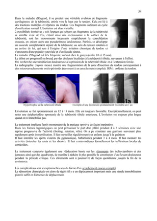 54
Dans la maladie d'Osgood, il se produit une véritable avulsion de fragments
cartilagineux de la tubérosité, attirés vers le haut par le tendon. Cela est lié à
des tractions multiples et répétées du tendon. Ces fragments subiront un cycle
d'ossification normal. L'évolution est alors variable:
2 possibilités évolutives ; soit l'espace qui sépare ces fragments de la tubérosité
se comble avec de l'os, créant ainsi une excroissance à la surface de la
tubérosité, soit les mouvements incessants empêcheront la consolidation
osseuse, en créant alors une pseudarthrose douloureuse. Parfois, se développe
un ossicule complètement séparé de la tubérosité, au sein du tendon rotulien et
en arrière de lui, qui sera à l'origine d'une irritation chronique du tendon et
s'entourera d'une pseudo synoviale et d'un liquide séreux.
La maladie d'Osgood est très fréquente, surtout chez le garçon (entre 10 et 15 ans).
Le début est progressif ou brutal, par des douleurs localisées à la tubérosité tibiale, survenant à l'effort.
On recherche une tuméfaction douloureuse à la pression de la tubérosité tibiale et à l’extension forcée.
La radiographie (rayons mous) montre une fragmentation de la zone d'insertion du tendon correspondant à
des micro-arrachements ostéo-périostés (rarement à un arrachement complet). IRM : oedème du tendon.
Hypertrophie de la tubérosité tibiale Exemple d’une évolution spontanément favorable en 1 an
L'évolution se fait spontanément en 12 à 18 mois. Elle est toujours favorable. Exceptionnellement, on peut
noter une épiphysiodèse spontanée de la tubérosité tibiale antérieure. L’évolution est toujours plus longue
quand on n’immobilise pas.
Le traitement implique l'arrêt momentané de la pratique sportive de façon impérative.
Dans les formes hyperalgiques on peut préconiser le port d'un plâtre pendant 4 à 6 semaines avec une
reprise progressive de l'activité (footing, natation, vélo). On a pu constater une guérison survenant plus
rapidement après immobilisation. Il faut surveiller régulièrement ces enfants jusqu’à la guérison
Il faut interdire les sports violents (la gymnastique, l'athlétisme) pendant 3 à 4 mois. Il faut moduler les
activités (interdire les sauts et les shoots). Il faut contre-indiquer formellement les infiltrations locales de
corticoïdes.
Le traitement comporte également une rééducation basée sur les étirements des ischio-jambiers et des
jumeaux ainsi que des quadriceps, de manière à réduire le plus possible la constitution d'un flexum douloureux
pendant la période critique. Ces étirements sont à poursuivre de façon quotidienne jusqu'à la fin de la
croissance.
Les complications sont exceptionnelles sous la forme d'un arrachement osseux complet.
La réinsertion chirurgicale est alors de règle s'il y a un déplacement important mais une simple immobilisation
plâtrée suffit en l'absence de déplacement.
 