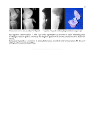 55
s
Arrachement osseux dans le cadre d’un Osgood Séquelle d’Osgood : saillie ou fragment détaché (aspect op)
Les séquelles sont fréquentes. Il peut s'agir d'une hypertrophie de la tubérosité tibiale antérieure parfois
inesthétique. On note parfois l'existence d'un fragment persistant et détaché derrière l'insertion du tendon
rotulien.
Lorsque ce fragment est volumineux et gênant, l'intervention consiste à l'enlever simplement. On découvre
un fragment osseux avec du cartilage.
-------------------------------------------------
 