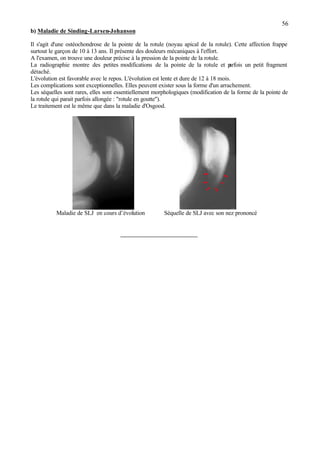 56
b) Maladie de Sinding-Larsen-Johanson
Il s'agit d'une ostéochondrose de la pointe de la rotule (noyau apical de la rotule). Cette affection frappe
surtout le garçon de 10 à 13 ans. Il présente des douleurs mécaniques à l'effort.
A l'examen, on trouve une douleur précise à la pression de la pointe de la rotule.
La radiographie montre des petites modifications de la pointe de la rotule et parfois un petit fragment
détaché.
L'évolution est favorable avec le repos. L'évolution est lente et dure de 12 à 18 mois.
Les complications sont exceptionnelles. Elles peuvent exister sous la forme d'un arrachement.
Les séquelles sont rares, elles sont essentiellement morphologiques (modification de la forme de la pointe de
la rotule qui parait parfois allongée : "rotule en goutte").
Le traitement est le même que dans la maladie d'Osgood.
Maladie de SLJ en cours d’évolution Séquelle de SLJ avec son nez prononcé
________________________
 