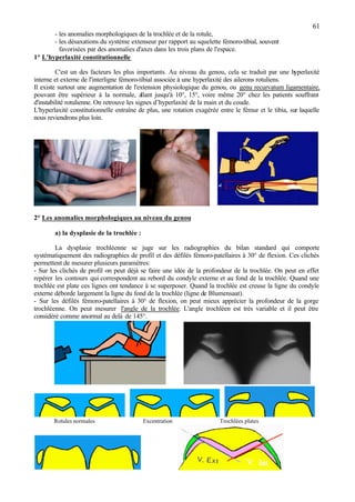 61
- les anomalies morphologiques de la trochlée et de la rotule,
- les désaxations du système extenseur par rapport au squelette fémoro-tibial, souvent
favorisées par des anomalies d'axes dans les trois plans de l'espace.
1° L'hyperlaxité constitutionnelle
C'est un des facteurs les plus importants. Au niveau du genou, cela se traduit par une hyperlaxité
interne et externe de l'interligne fémoro-tibial associée à une hyperlaxité des ailerons rotuliens.
Il existe surtout une augmentation de l'extension physiologique du genou, ou genu recurvatum ligamentaire,
pouvant être supérieur à la normale, allant jusqu'à 10°, 15°, voire même 20° chez les patients souffrant
d'instabilité rotulienne. On retrouve les signes d’hyperlaxité de la main et du coude.
L'hyperlaxité constitutionnelle entraîne de plus, une rotation exagérée entre le fémur et le tibia, sur laquelle
nous reviendrons plus loin.
2° Les anomalies morphologiques au niveau du genou
a) la dysplasie de la trochlée :
La dysplasie trochléenne se juge sur les radiographies du bilan standard qui comporte
systématiquement des radiographies de profil et des défilés fémoro-patellaires à 30° de flexion. Ces clichés
permettent de mesurer plusieurs paramètres:
- Sur les clichés de profil on peut déjà se faire une idée de la profondeur de la trochlée. On peut en effet
repérer les contours qui correspondent au rebord du condyle externe et au fond de la trochlée. Quand une
trochlée est plate ces lignes ont tendance à se superposer. Quand la trochlée est creuse la ligne du condyle
externe déborde largement la ligne du fond de la trochlée (ligne de Blumensaat).
- Sur les défilés fémoro-patellaires à 30° de flexion, on peut mieux apprécier la profondeur de la gorge
trochléenne. On peut mesurer l'angle de la trochlée. L'angle trochléen est très variable et il peut être
considéré comme anormal au delà de 145°.
Rotules normales Excentration Trochlées plates
 