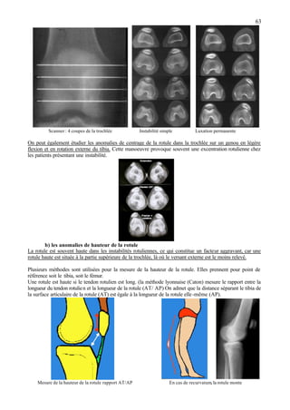 63
Scanner : 4 coupes de la trochlée Instabilité simple Luxation permanente
On peut également étudier les anomalies de centrage de la rotule dans la trochlée sur un genou en légère
flexion et en rotation externe du tibia. Cette manoeuvre provoque souvent une excentration rotulienne chez
les patients présentant une instabilité.
b) les anomalies de hauteur de la rotule
La rotule est souvent haute dans les instabilités rotuliennes, ce qui constitue un facteur aggravant, car une
rotule haute est située à la partie supérieure de la trochlée, là où le versant externe est le moins relevé.
Plusieurs méthodes sont utilisées pour la mesure de la hauteur de la rotule. Elles prennent pour point de
référence soit le tibia, soit le fémur.
Une rotule est haute si le tendon rotulien est long. (la méthode lyonnaise (Caton) mesure le rapport entre la
longueur du tendon rotulien et la longueur de la rotule (AT/ AP) On admet que la distance séparant le tibia de
la surface articulaire de la rotule (AT) est égale à la longueur de la rotule elle-même (AP).
Mesure de la hauteur de la rotule rapport AT/AP En cas de recurvatum, la rotule monte
 