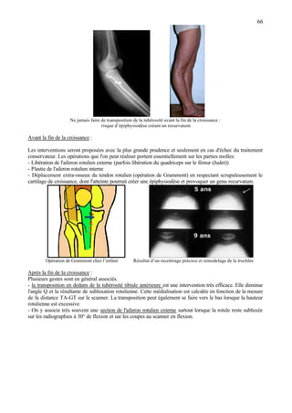 66
Ne jamais faire de transposition de la tubérosité avant la fin de la croissance :
risque d’épiphysiodèse créant un recurvatum
Avant la fin de la croissance :
Les interventions seront proposées avec la plus grande prudence et seulement en cas d'échec du traitement
conservateur. Les opérations que l'on peut réaliser portent essentiellement sur les parties molles:
- Libération de l'aileron rotulien externe (parfois libération du quadriceps sur le fémur (Judet))
- Plastie de l'aileron rotulien interne
- Déplacement extra-osseux du tendon rotulien (opération de Grammont) en respectant scrupuleusement le
cartilage de croissance, dont l'atteinte pourrait créer une épiphysiodèse et provoquer un genu recurvatum.
Opération de Grammont chez l’enfant Résultat d’un recentrage précoce et remodelage de la trochlée
Après la fin de la croissance :
Plusieurs gestes sont en général associés.
- la transposition en dedans de la tubérosité tibiale antérieure est une intervention très efficace. Elle diminue
l'angle Q et la résultante de subluxation rotulienne. Cette médialisation est calculée en fonction de la mesure
de la distance TA-GT sur le scanner. La transposition peut également se faire vers le bas lorsque la hauteur
rotulienne est excessive.
- On y associe très souvent une section de l'aileron rotulien externe surtout lorsque la rotule reste subluxée
sur les radiographies à 30° de flexion et sur les coupes au scanner en flexion.
 