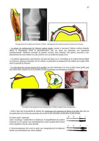 67
Transposition de la tubérosité (Elmslie-Trillat) Allongement de l’aileron externe et tension de l’interne
- La plastie de renforcement de l'aileron rotulien interne consiste à raccourcir l'aileron rotulien distendu
depuis le traumatisme initial et particulièrement chez les sujets qui présentent une hyperlaxité
constitutionnelle. Différents procédés de plasties existent, dont certaines sont parfois associées à des
abaissements du vaste interne ou a des renforts avec un tendon de la patte d'oie.
- Les plasties ligamentaires anti-rotatoires ont pour but d'agir sur le verrouillage de la rotation fémoro-tibiale
en extension. (plusieurs procédés ont été utilisés, en particulier la transposition des tendons de la patte d'Oie
selon le procédé de Slocum).
- Le relèvement du versant externe de la trochlée, par une ostéotomie et la mise en place d'une greffe, peut
être réalisé dans certains cas où la trochlée est très dysplasique (trochléoplastie d'Albee).
Exemple d’une opération de trochléoplastie d’Albee couplée à une transposition :
- Enfin il faut citer la possibilité de réaliser des ostéotomies de correction du fémur et du tibia dans des cas
très particuliers où il existe des anomalies de torsion ou des anomalies axiales dans le plan frontal.
Evolution après traitement
Après recentrage l’amélioration se traduit par la rééquilibration du système
extenseur et l’on assiste à une normalisation du vastus medialis dont l’action
tend à équilibrer celle du vastus lateralis
L’électromyogramme fait avant et après une transposition de la tubérosité
montre une normalisation du vastus médialis
 