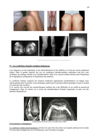 69
________________________________
5° - Les syndrômes chondro rotuliens douloureux
Leur fréquence est très importante et leur démembrement est très difficile et il n'est pas encore totalement
réalisé. Dans la grande majorité des cas ces syndromes chondro-rotuliens douloureux sont liés à une
souffrance du cartilage rotulien avec chondromalacie. Mais il n'y a pas de relation absolue entre l'importance
de la dégradation cartilagineuse et l'importance des douleurs.
Le syndrome clinique comporte des douleurs rotuliennes apparaissant essentiellement à la fatigue mais
surtout gênante pour la position assise prolongée, parfois pour la position debout prolongée et pour la montée
et la descente des escaliers.
Il s'y associe très souvent des pseudo-blocages rotuliens liés à des difficultés ou un conflit au moment de
l'engagement. Dans les formes où il existe une chondromalacie fissuraire importante, on peut voir des
épisodes d'hydarthrose.
Chondropatie fissuraire mise en évidence par l’IRM
Circonstances étiologiques
Le syndrome rotulien post-traumatique survient à la suite d'un choc direct sur la partie antérieure de la rotule.
Il évolue dans la plupart des cas favorablement, mais l'évolution est longue.
 