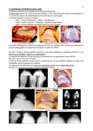 71
L'ARTHROSE FÉMORO-PATELLAIRE
L'arthrose correspond à une altération du revêtement cartilagineux.
L'arthroscopie permet une vision directe des cartilages et une classification des lésions macroscopiques. Il
y a souvent des lésions de chondromalacie de la rotule chez les sujets jeunes.
La chondromalacie se classe en 3 stades :
- stade 1 : lésions superficielles - œdème - ramollissement
- stade 2 : lésions moyennes - fissurations - ulcérations superficielles
- stade 3 : lésions ulcérantes profondes jusqu'à l'os sous-chondral.
Chondromalacie fissuraire Arthrose de la trochlée et de la rotule
Les lésions cartilagineuses peuvent être explorées aussi par des examens moins invasifs que l'arthroscopie,
comme l'arthrographie avec injection de contraste, le scanner et l'IRM.
On parle d'arthrose fémoro-patellaire quand il y a une usure cartilagineuse importante et quand il y a un
pincement de l'interligne visible sur les radiographies.
La majorité des arthroses FP sont associées à des arthroses des compartiments fémoro tibiaux.
Plus rares sont les arthroses FP isolées
L'arthrose fémoro-patellaire survient, dans la majorité des cas, sur une instabilité rotulienne ancienne ou un
déséquilibre ancien longtemps bien supporté.
La majorité des cas présentent une usure du compartiment externe et une subluxation externe.
On peut voir, rarement, des arthroses fémoro-patellaires internes.
Cas le plus fréquent : arthrose FP dans le cadre d’une arthrose globale
Arthrose FP externe La subluxation augmente en flexion
 