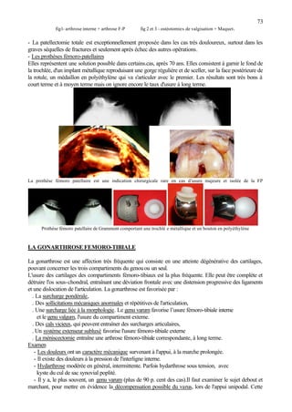73
fig1- arthrose interne + arthrose F-P fig 2 et 3 - ostéotomies de valgisation + Maquet.
- La patellectomie totale est exceptionnellement proposée dans les cas très douloureux, surtout dans les
graves séquelles de fractures et seulement après échec des autres opérations.
- Les prothèses fémoro-patellaires
Elles représentent une solution possible dans certains.cas, après 70 ans. Elles consistent à garnir le fond de
la trochlée, d'un implant métallique reproduisant une gorge régulière et de sceller, sur la face postérieure de
la rotule, un médaillon en polyéthylène qui va s'articuler avec le premier. Les résultats sont très bons à
court terme et à moyen terme mais on ignore encore le taux d'usure à long terme.
La prothèse fémoro patellaire est une indication chirurgicale rare en cas d’usure majeure et isolée de la FP
Prothèse fémoro patellaire de Grammont comportant une trochlé e métallique et un bouton en polyéthylène
LA GONARTHROSE FEMORO-TIBIALE
La gonarthrose est une affection très fréquente qui consiste en une atteinte dégénérative des cartilages,
pouvant concerner les trois compartiments du genouou un seul.
L'usure des cartilages des compartiments fémoro-tibiaux est la plus fréquente. Elle peut être complète et
détruire l'os sous-chondral, entraînant une déviation frontale avec une distension progressive des ligaments
et une dislocation de l'articulation. La gonarthrose est favorisée par :
. La surcharge pondérale,
. Des sollicitations mécaniques anormales et répétitives de l'articulation,
. Une surcharge liée à la morphologie. Le genu varum favorise l’usure fémoro-tibiale interne
et le genu valgum, l'usure du compartiment externe.
. Des cals vicieux, qui peuvent entraîner des surcharges articulaires,
. Un système extenseur subluxé favorise l'usure fémoro-tibiale externe
. La méniscectomie entraîne une arthrose fémoro-tibiale correspondante, à long terme.
Examen
- Les douleurs ont un caractère mécanique survenant à l'appui, à la marche prolongée.
- Il existe des douleurs à la pression de l'interligne interne.
- Hydarthrose modérée en général, intermittente. Parfois hydarthrose sous tension, avec
kyste du cul de sac synovial poplité.
- Il y a, le plus souvent, un genu varum (plus de 90 p. cent des cas).Il faut examiner le sujet debout et
marchant, pour mettre en évidence la décompensation possible du varus, lors de l'appui unipodal. Cette
 