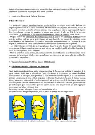 75
Les chondro-protecteurs ont certainement un rôle bénéfique, mais seul le traitement chirurgicalest capable
de modifier les conditions mécaniques et de freiner l'évolution.
- Le traitement chirurgical de l'arthrose du genou
1/ Les ostéotomies
Les ostéotomies corrigent les défauts d'axe du membre inférieur et soulagent beaucoup les douleurs, tout
en prolongeant la durée de la vie de l'articulation. On a l’habitude de corriger les déformations, au delà de
la «normo-correction », dans les arthroses internes, pour lesquelles on crée un léger valgus (3 degrés).
Pour les arthroses externes, on supprime le valgus, sans chercher à aller au delà de la « normo-
correction ». Les ostéotomies se font au niveau des métaphyses du tibia ou du fémur, selon les cas.
- On peut réaliser des ostéotomies de soustraction osseuse, en coin ou des ostéotomies d'addition utilisant
soit des greffons prélevés sur la crête iliaque, soit des allogreffes ou encore des substituts osseux
synthétiques (qui ont l'inconvénient de consolider un peu plus lentement mais qui ont l’avantage de ne pas
risquer de contaminations virales ou microbiennes comme en sont responsables les allogreffes)
- Les ostéosynthèses sont réalisées avec des plaques et des vis et elles doivent être assez solides pour
permettre une rééducation rapide et un appui aussi précoce que possible (variable selon l'âge, la solidité de
l'os et de l'ostéosynthèse, de 1 à 60 jours).
- Outre la correction axiale frontale, on peut aussi apporter des modifications au système rotulien, par un
recentrage de la tubérosité tibiale, avec éventuellement un avancement qui a pour effet de modifier les
pressions fémoro-patellaires.
A / Les ostéotomies dans l’arthrose fémoro-tibiale interne
1 - Ostéotomie tibiale de valgisation par fermeture
Après incision cutanée rectiligne antéro-externe, ouverture de l'aponévrose jambière et rugination de la
partie osseuse, située sous le tubercule de Gerdy. On dégage la face externe, qui recevra la plaque
d'ostéosynthèse et on rugine, avec prudence, la face postérieure derrière laquelle, il y a des vaisseaux
poplités. L'ostéotomie du tibia est faite au ciseau, ou à la scie. Soustraction d'un coin de hauteur choisie,
d'après les mesures radio, puis le péroné est sectionné, soit au tiers moyen de la diaphyse, soit au niveau
du col du péroné. Mise en contact des tranches osseuses et vérification de la correction (par une radio ou
par radioscopie) puis ostéosynthèse par des agrafes ou une lame-plaque vissée, qui doit s'appliquer
correctement sur la face externe du tibia.
Le montage est assez solide pour éviter toute immobilisation stricte.
La rééducation est entreprise rapidement, mais le genou est protégé par une simple attelle.
Arthrose interne: ostéotomie de valgisation par fermeture externe Légère hypercorrection en valgus
 