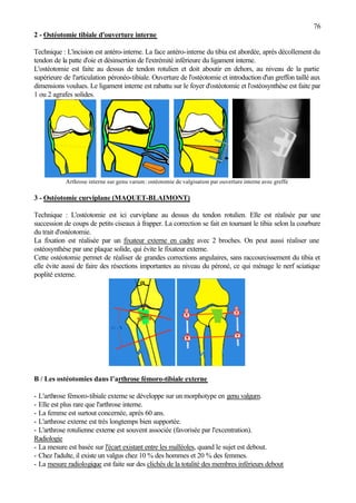 76
2 - Ostéotomie tibiale d'ouverture interne
Technique : L'incision est antéro-interne. La face antéro-interne du tibia est abordée, après décollement du
tendon de la patte d'oie et désinsertion de l'extrémité inférieure du ligament interne.
L'ostéotomie est faite au dessus de tendon rotulien et doit aboutir en dehors, au niveau de la partie
supérieure de l'articulation péronéo-tibiale. Ouverture de l'ostéotomie et introduction d'un greffon taillé aux
dimensions voulues. Le ligament interne est rabattu sur le foyer d'ostéotomie et l'ostéosynthèse est faite par
1 ou 2 agrafes solides.
Arthrose interne sur genu varum: ostéotomie de valgisation par ouverture interne avec greffe
3 - Ostéotomie curviplane (MAQUET-BLAIMONT)
Technique : L'ostéotomie est ici curviplane au dessus du tendon rotulien. Elle est réalisée par une
succession de coups de petits ciseaux à frapper. La correction se fait en tournant le tibia selon la courbure
du trait d'ostéotomie.
La fixation est réalisée par un fixateur externe en cadre avec 2 broches. On peut aussi réaliser une
ostéosynthèse par une plaque solide, qui évite le fixateur externe.
Cette ostéotomie permet de réaliser de grandes corrections angulaires, sans raccourcissement du tibia et
elle évite aussi de faire des résections importantes au niveau du péroné, ce qui ménage le nerf sciatique
poplité externe.
B / Les ostéotomies dans l’arthrose fémoro-tibiale externe
- L'arthrose fémoro-tibiale externe se développe sur un morphotype en genu valgum.
- Elle est plus rare que l'arthrose interne.
- La femme est surtout concernée, après 60 ans.
- L'arthrose externe est très longtemps bien supportée.
- L'arthrose rotulienne externe est souvent associée (favorisée par l'excentration).
Radiologie
- La mesure est basée sur l'écart existant entre les malléoles, quand le sujet est debout.
- Chez l'adulte, il existe un valgus chez 10 % des hommes et 20 % des femmes.
- La mesure radiologique est faite sur des clichés de la totalité des membres inférieurs debout
 