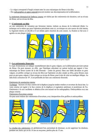 77
- Le valgus correspond à l'angle existant entre les axes mécaniques du fémur et du tibia.
- Des radiographies en appui unipodal peuvent montrer une décompensation de la déformation.
Le traitement chirurgical de l'arthrose externe est réalisé par des ostéotomies de réaxation, soit au niveau
du fémur, soit au niveau du tibia.
1 - L'ostéotomie au tibia
est une ostéotomie de varisation par fermeture interne, réalisée au dessus de la tubérosité tibiale. La
technique est la même que pour l'opération précédente mais ici, on résèque un coin osseux du côté interne.
Le ligament interne est décollé et il est rabattu après résection du coin osseux. La fixation se fait avec 2
agrafes ou une plaque vissée.
Ostéotomie de soustraction interne corrigeant un genu valgum
2 - Les ostéotomies fémorales
Ce type d'ostéotomie est indiqué essentiellement dans le genu valgum, car la déformation provient surtout
du fémur. On peut mesurer, en effet, que l'interligne articulaire est surtout incliné par rapport à l'axe
mécanique du fémur (centre de la tête fémorale - centre du genou). Dans une faible déviation en genu
valgum, on préfère corriger au niveau du tibia (car l'opération est plus simple au tibia, qu'au fémur), mais
pour un gros genu valgum, il faut corriger au niveau du fémur, pour éviter de créer un interligne oblique. Au
delà d'une correction de 10°, il est préférable de faire une ostéotomie fémorale.
Ostéotomie de soustraction interne
Technique: Incision à la face externe de la diaphyse jusqu'au tendon rotulien et ouverture du fascia lata. Le
vaste externe est ruginé à la face externe de la diaphyse et rugination antérieure et postérieure de l'os.
Ostéotomie à la scie oscillante et ablation d'un coin mesuré sur les radiographies. Ostéosynthèse avec une
plaque externe.
Ostéotomie d'ouverture externe
On peut aussi réaliser des ostéotomies d'ouverture, avec interposition d'un greffon et ostéosynthèse.
Ostéotomie fémorale d’ouverture externe Ostéotomie de fermeture interne
Le résultat des ostéotomies est globalement bon, permettant de diminuer, ou de supprimer les douleurs,
pendant une durée qui est de 10 ans en moyenne, parfois plus de 15 ans.
 