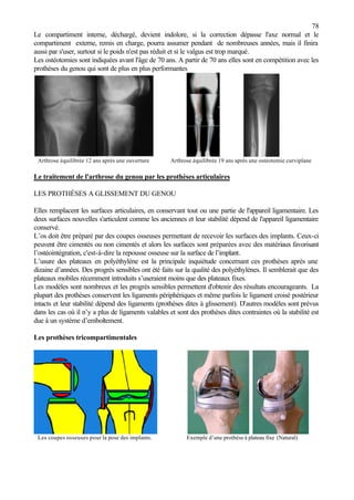 78
Le compartiment interne, déchargé, devient indolore, si la correction dépasse l'axe normal et le
compartiment externe, remis en charge, pourra assumer pendant de nombreuses années, mais il finira
aussi par s'user, surtout si le poids n'est pas réduit et si le valgus est trop marqué.
Les ostéotomies sont indiquées avant l'âge de 70 ans. A partir de 70 ans elles sont en compétition avec les
prothèses du genou qui sont de plus en plus performantes
Arthrose équilibrée 12 ans après une ouverture Arthrose équilibrée 19 ans après une ostéotomie curviplane
Le traitement de l'arthrose du genou par les prothèses articulaires
LES PROTHÉSES A GLISSEMENT DU GENOU
Elles remplacent les surfaces articulaires, en conservant tout ou une partie de l'appareil ligamentaire. Les
deux surfaces nouvelles s'articulent comme les anciennes et leur stabilité dépend de l'appareil ligamentaire
conservé.
L’os doit être préparé par des coupes osseuses permettant de recevoir les surfaces des implants. Ceux-ci
peuvent être cimentés ou non cimentés et alors les surfaces sont préparées avec des matériaux favorisant
l’ostéointégration, c'est-à-dire la repousse osseuse sur la surface de l’implant.
L’usure des plateaux en polyéthylène est la principale inquiétude concernant ces prothèses après une
dizaine d’années. Des progrès sensibles ont été faits sur la qualité des polyéthylènes. Il semblerait que des
plateaux mobiles récemment introduits s’useraient moins que des plateaux fixes.
Les modèles sont nombreux et les progrès sensibles permettent d'obtenir des résultats encourageants. La
plupart des prothèses conservent les ligaments périphériques et même parfois le ligament croisé postérieur
intacts et leur stabilité dépend des ligaments (prothèses dites à glissement). D’autres modèles sont prévus
dans les cas où il n’y a plus de ligaments valables et sont des prothèses dites contraintes où la stabilité est
due à un système d’emboîtement.
Les prothèses tricompartimentales
Les coupes osseuses pour la pose des implants. Exemple d’une prothèse à plateau fixe (Natural)
 