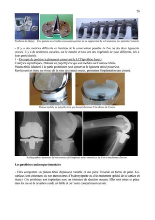 79
Prothèse de Depuy Une gamme avec tailles croissantes permet de se rapprocher de la l’anatomie des patients (Natural)
- Il y a des modèles différents en fonction de la conservation possible de l'un ou des deux ligaments
croisés. Il y a de nombreux modèles, sur le marché et tous ont des impératifs de pose différents, liés à
leurs particularités.
1 - Exemple de prothèse à glissement conservant le LCP (prothèse Innex)
Condyles asymétriques. Plateaux en polyéthylène qui sont mobiles sur l’embase tibiale.
Plateau tibial échancré à la partie postérieure pour conserver le ligament croisé postérieur.
Revêtement en titane au niveau de la zone de contact osseux, permettant l'implantation sans ciment.
Plateau mobile en polyéthylène qui devrait diminuer l’incidence de l’usure
Radiographies montrant le bon contact des implants non cimentés et de l’os et une bonne flexion
Les prothèses unicompartimentales
- Elles comportent un plateau tibial d'épaisseur variable et une pièce fémorale en forme de patin. Les
surfaces sont cimentées ou non (recouvertes d’hydroxyapatite ou d’un traitement spécial de la surface en
titane). Ces prothèses sont implantées avec un minimum de résection osseuse. Elles sont mises en place
dans les cas où la déviation axiale est faible et où l’autre compartiment est sain.
 