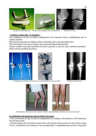 80
Exemple d’une prothèse uni Surface hydroxyapatite pour la réhabitation Radio profil et face
- Prothèses totales dites "à charnière"
Elles remplacent à la fois, les surfaces cartilagineuses et les ligaments croisés et périphériques, par un
système contraint.
Elles prennent appui dans les diaphyses tibiale et fémorale, grâce à des tiges diaphysaires.
Elles sont destinées à des genoux détruits sans conservation ligamentaire possible.
Certains modèles n'ont qu'une possibilité de flexion extension, ce sont les vraies "prothèses charnières",
d'autres ont une possibilité de rotation.
Exemple d’une prothèse contrainte avec l’emboîtement de 2 pièces (Link) Prothèse de Bousquet
Arthropathies destructrices des 2 genoux Opération par prothèses charnières en raison de la laxité
Les indications thérapeutiques dans l'arthrose du genou
- Elles sont fonction de l'âge, de l'état de la dégradation des cartilages et des ligaments et de l'importance
de la déviation axiale.
- On peut proposer des interventions conservatrices de réaxation même pour des cas très évolués et après
70 ans. L'amélioration sur la douleur est souvent appréciable. La dégradation peut survenir à long terme
 