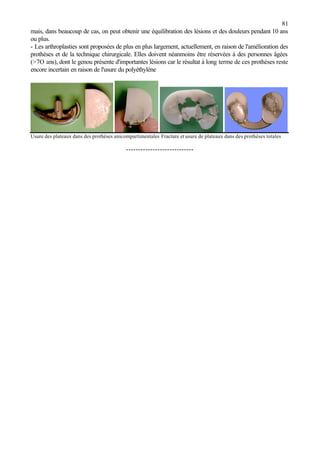 81
mais, dans beaucoup de cas, on peut obtenir une équilibration des lésions et des douleurs pendant 10 ans
ou plus.
- Les arthroplasties sont proposées de plus en plus largement, actuellement, en raison de l'amélioration des
prothèses et de la technique chirurgicale. Elles doivent néanmoins être réservées à des personnes âgées
(>7O ans), dont le genou présente d'importantes lésions car le résultat à long terme de ces prothèses reste
encore incertain en raison de l'usure du polyéthylène
Usure des plateaux dans des prothèses unicompartimentales Fracture et usure de plateaux dans des prothèses totales
----------------------------
 