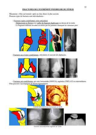 82
FRACTURES DE L'EXTRÉMITÉ INFERIEURE DU FÉMUR
Mécanisme : Elles surviennent après un choc direct, le plus souvent.
Plusieurs types de fractures sont individualisées :
- Fractures supra-condyliennes extra-articulaires
. Déplacement en flexion avec saillie du fragment diaphysaire au dessus de la rotule.
. Le fragment inférieur est attiré en arrière par les jumeaux menaçant les vaisseaux post.
- Fractures sus et inter-condyliennes, articulaires et souvent très déplacées.
- Fractures uni-condyliennes, qui sont, horizontales (HOFFA), sagittales (TRÉLAT) ou intermédiaires.
Elles peuvent s’accompagner de lésions ligamentaires.
Fracture unicondylienne horizontale de Hoffa
Fracture unicondylienne sagittale de Trélat
 