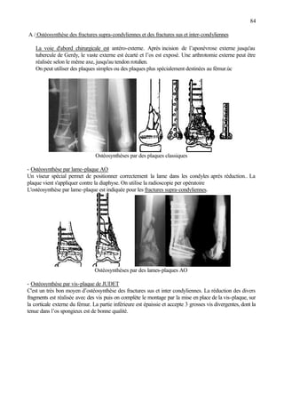 84
A / Ostéosynthèse des fractures supra-condyliennes et des fractures sus et inter-condyliennes
La voie d'abord chirurgicale est antéro-externe. Après incision de l’aponévrose externe jusqu'au
tubercule de Gerdy, le vaste externe est écarté et l’os est exposé. Une arthrotomie externe peut être
réalisée selon le même axe, jusqu'au tendon rotulien.
On peut utiliser des plaques simples ou des plaques plus spécialement destinées au fémur.ùc
Ostéosynthèses par des plaques classiques
- Ostéosynthèse par lame-plaque AO
Un viseur spécial permet de positionner correctement la lame dans les condyles après réduction.. La
plaque vient s'appliquer contre la diaphyse. On utilise la radioscopie per opératoire
L'ostéosynthèse par lame-plaque est indiquée pour les fractures supra-condyliennes.
Ostéosynthèses par des lames-plaques AO
- Ostéosynthèse par vis-plaque de JUDET
C'est un très bon moyen d’ostéosynthèse des fractures sus et inter condyliennes. La réduction des divers
fragments est réalisée avec des vis puis on complète le montage par la mise en place de la vis-plaque, sur
la corticale externe du fémur. La partie inférieure est épaissie et accepte 3 grosses vis divergentes, dont la
tenue dans l’os spongieux est de bonne qualité.
 