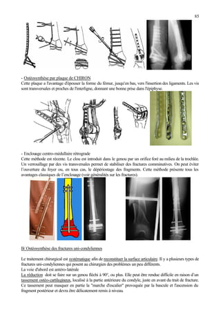 85
- Ostéosynthèse par plaque de CHIRON
Cette plaque a l'avantage d'épouser la forme du fémur, jusqu'en bas, vers l'insertion des ligaments. Les vis
sont transversales et proches de l'interligne, donnant une bonne prise dans l'épiphyse.
- Enclouage centro-médullaire rétrograde
Cette méthode est récente. Le clou est introduit dans le genou par un orifice foré au milieu de la trochlée.
Un verrouillage par des vis transversales permet de stabiliser des fractures comminutives. On peut éviter
l’ouverture du foyer ou, en tous cas, le dépériostage des fragments. Cette méthode présente tous les
avantages classiques de l’enclouage (voir généralités sur les fractures).
B/ Ostéosynthèse des fractures uni-condyliennes
Le traitement chirurgical est systématique afin de reconstituer la surface articulaire. Il y a plusieurs types de
fractures uni-condyliennes qui posent au chirurgien des problèmes un peu différents.
La voie d'abord est antéro-latérale
La réduction doit se faire sur un genou fléchi à 90°, ou plus. Elle peut être rendue difficile en raison d’un
tassement ostéo-cartilagineux, localisé à la partie antérieure du condyle, juste en avant du trait de fracture.
Ce tassement peut masquer en partie la "marche d'escalier" provoquée par la bascule et l'ascension du
fragment postérieur et devra être délicatement remis à niveau.
 