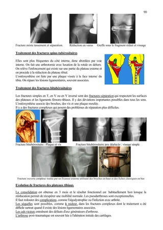 90
Fracture mixte tassement et séparation. Réduction en varus Greffe sous le fragment réduit et vissage
Traitement des fractures spino-tubérositaires
Elles sont plus fréquentes du côté interne, donc abordées par voie
interne. On fait une arthrotomie avec luxation de la rotule en dehors.
On relève l'enfoncement qui existe sur une partie du plateau externe et
on procède à la réduction du plateau tibial.
L'ostéosynthèse est faite par une plaque vissée à la face interne du
tibia. On répare les lésions ligamentaires, souvent associées.
Traitement des fractures bitubérositaires
Les fractures simples en T, en V ou en Y inversé sont des fractures-séparation qui respectent les surfaces
des plateaux et les ligaments fémoro-tibiaux. Il y des déviations importantes possibles dans tous les sens.
L'ostéosynthèse associe des broches, des vis et une plaque moulée.
Il y a des fractures complexes qui posent des problèmes de réparation plus difficiles.
Fracture bitubérositaire : Plaque et vis Fracture bitubérositaire peu déplacée : vissage simple
Fracture ouverte complexe traitée par un fixateur externe utilisant des broches en haut et des fiches classiques en bas
Evolution de fractures des plateaux tibiaux
La consolidation est obtenue en 3 mois et le résultat fonctionnel est habituellement bon lorsque la
rééducation permet de récupérer une mobilité normale. Les pseudarthroses sont exceptionnelles.
Il faut redouter des complications, comme l'algodystrophie ou l'infection avec arthrite.
Les séquelles sont possibles, comme la raideur, dans les fractures complexes dont le traitement a été
difficile surtout quand il existe des lésions ligamentaires associées.
Les cals vicieux entraînent des défauts d'axe générateurs d'arthrose.
L'arthrose post-traumatique est souvent liée à l'altération initiale des cartilages.
 